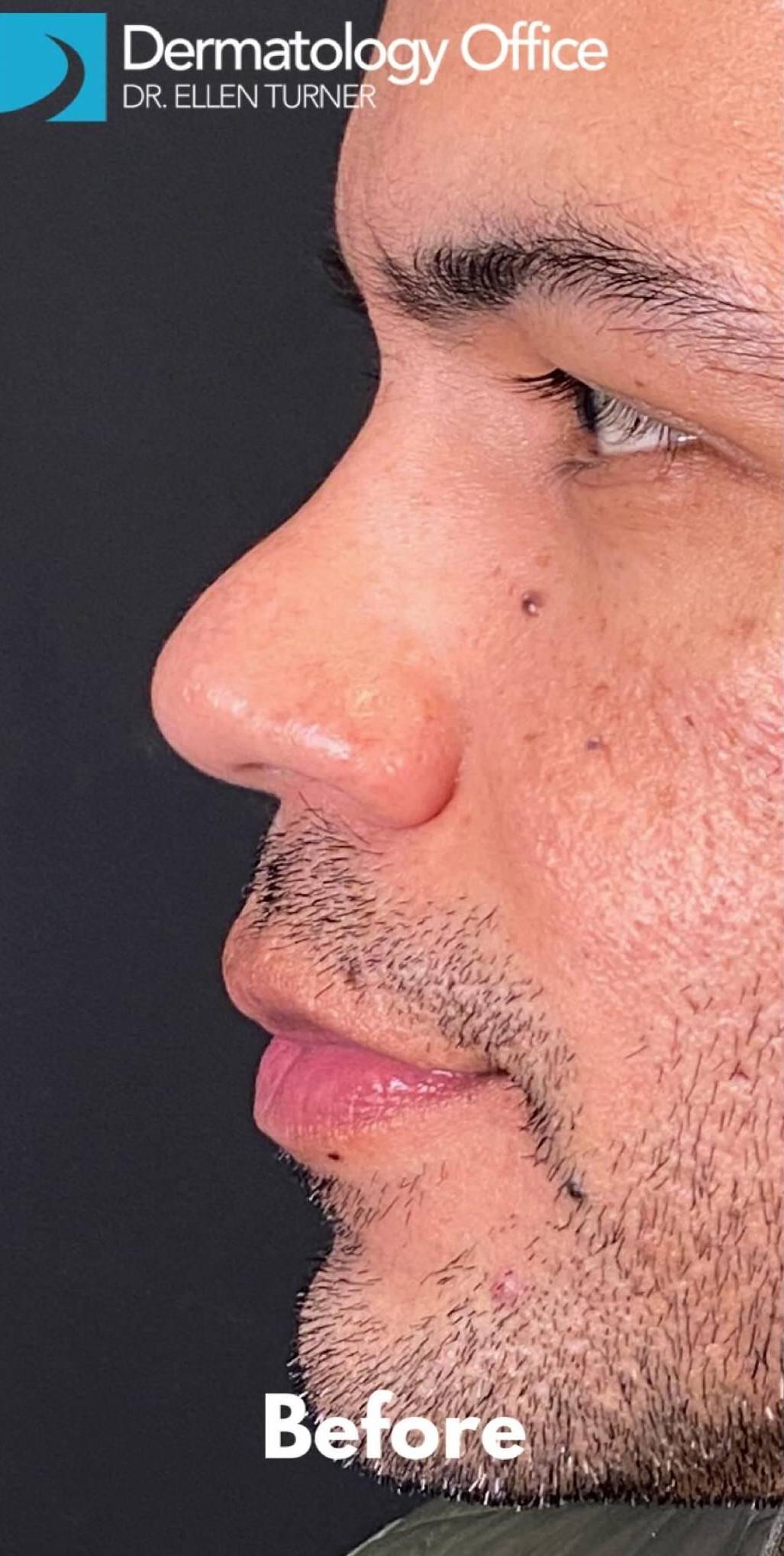 Facial Contouring and Filler for Men 30 Before