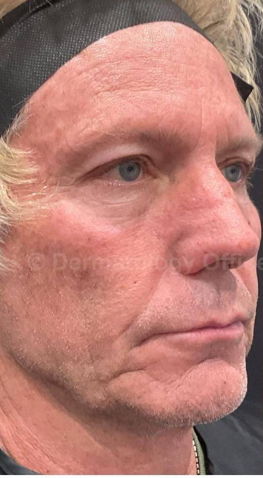 Restylane Before and After Case 31 Before