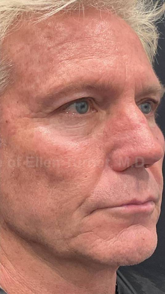 Restylane Before and After Case 31 After