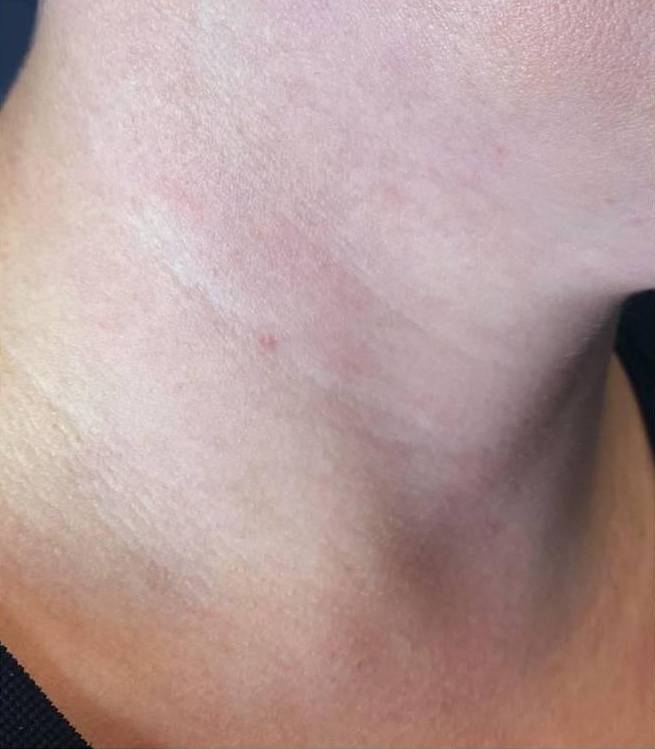 Restylane Before and After Case 6 Before