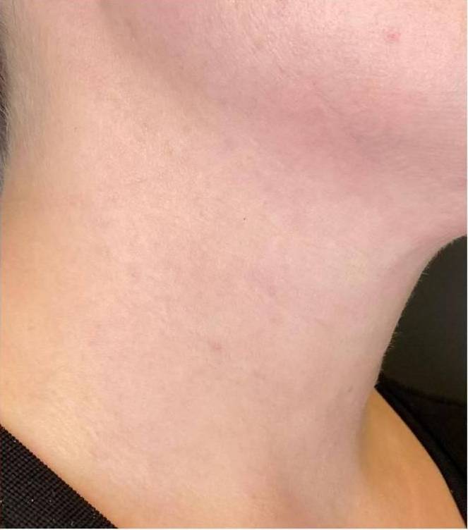 Restylane Before and After Case 6 After