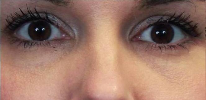 Restylane Before and After Case 5 Before