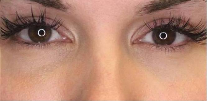 Restylane Before and After Case 5 After