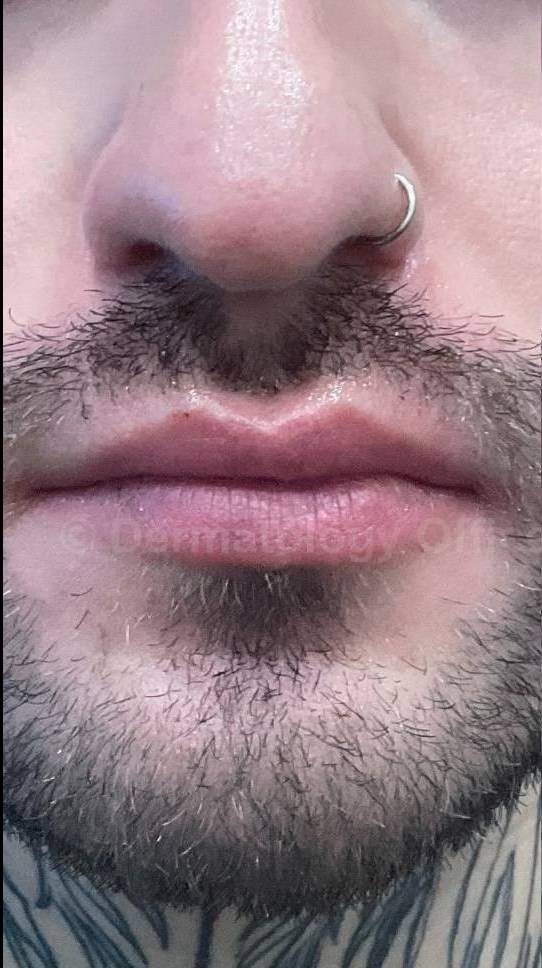 Restylane Before and After Case 33 Before