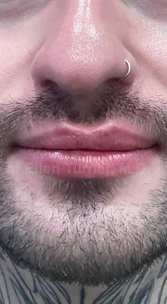 Restylane Before and After Case 33 After