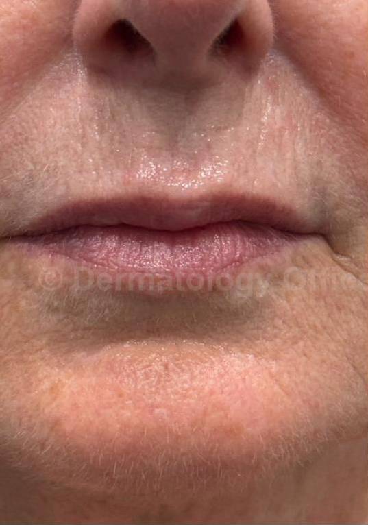 Restylane Before and After Case 32 Before