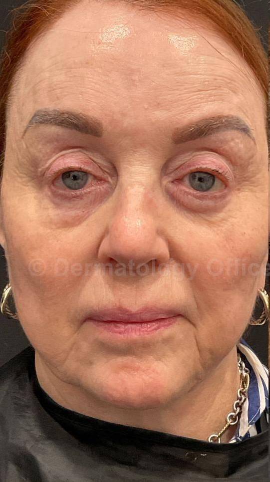 Restylane Before and After Case 30 Before