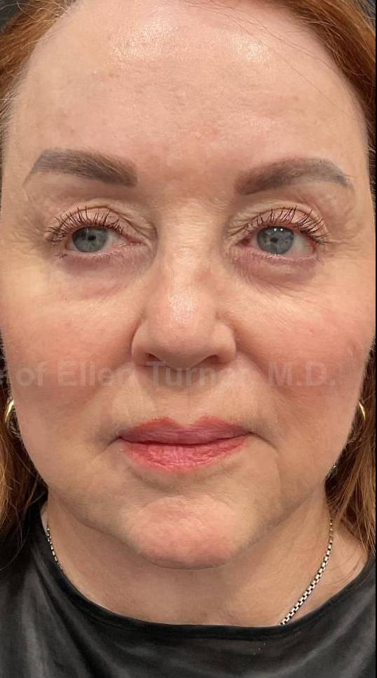 Restylane Before and After Case 30 After