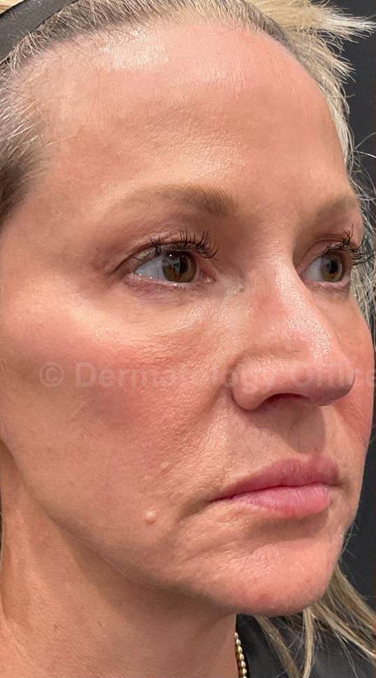 Restylane Before and After Case 29 Before