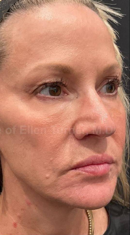Restylane Before and After Case 29 After