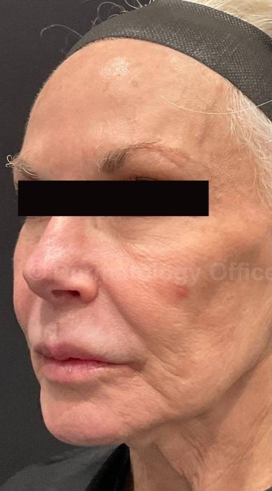 Restylane Before and After Case 28 Before