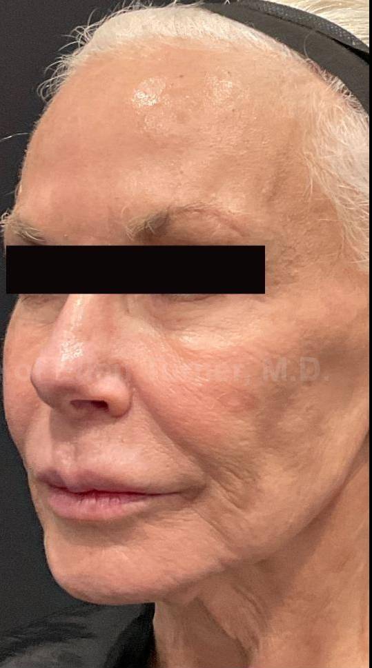 Restylane Before and After Case 28 After