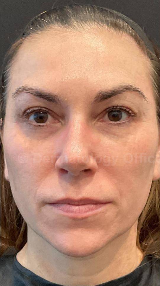 Restylane Before and After Case 25 Before