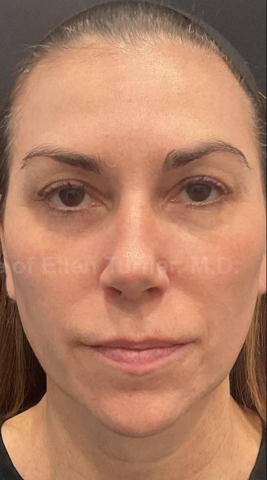 Restylane Before and After Case 25 After