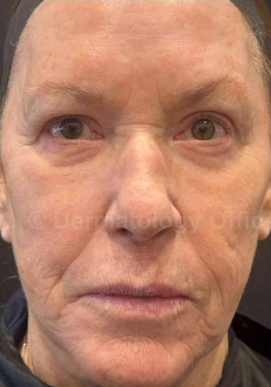 Restylane Before and After Case 24 Before