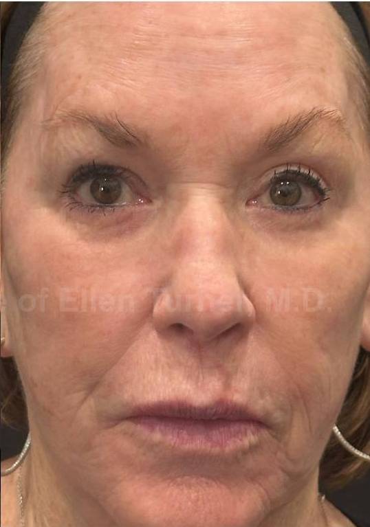 Restylane Before and After Case 24 After