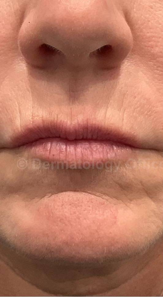 Restylane Before and After Case 23 Before