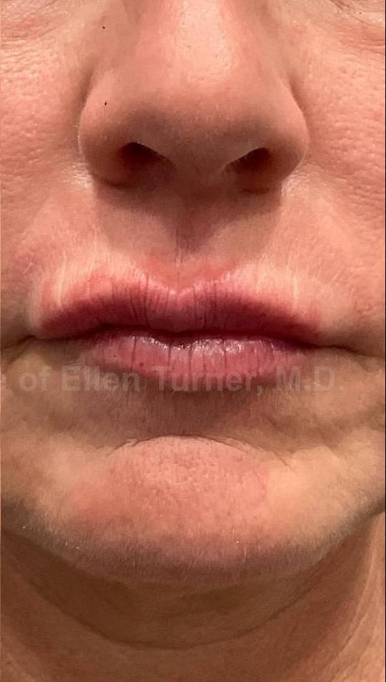 Restylane Before and After Case 23 After