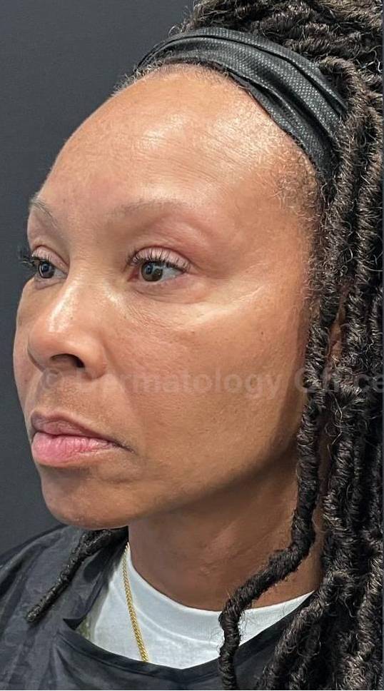 Restylane Before and After Case 22 Before