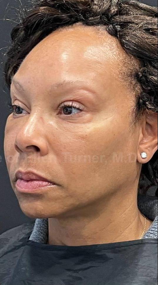 Restylane Before and After Case 22 After