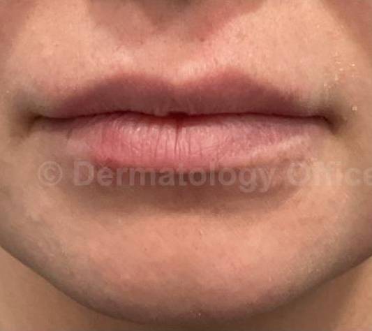 Restylane Before and After Case 21 Before