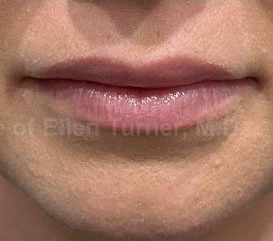 Restylane Before and After Case 21 After