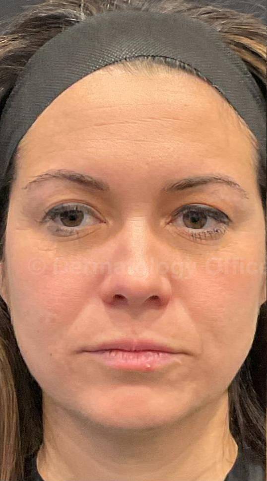 Restylane Before and After Case 19 Before