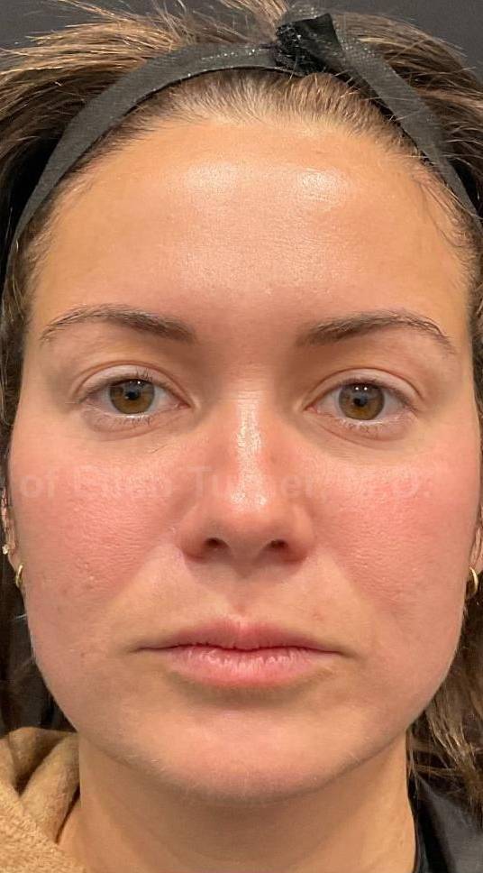 Restylane Before and After Case 19 After
