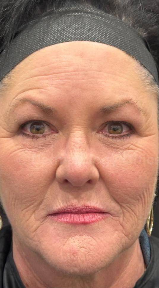 Restylane Before and After Case 18 Before