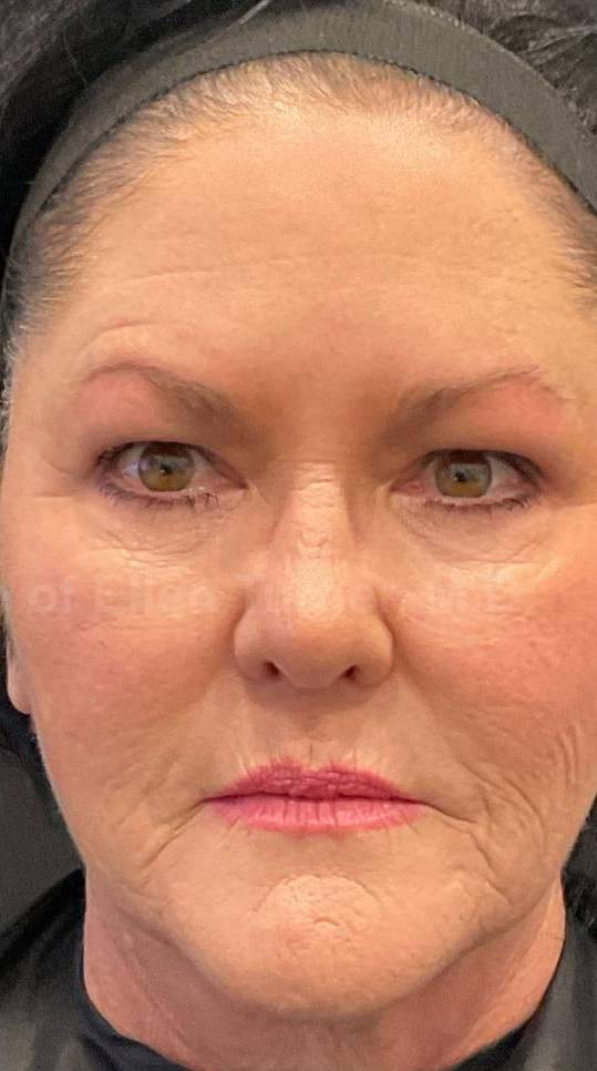 Restylane Before and After Case 18 After