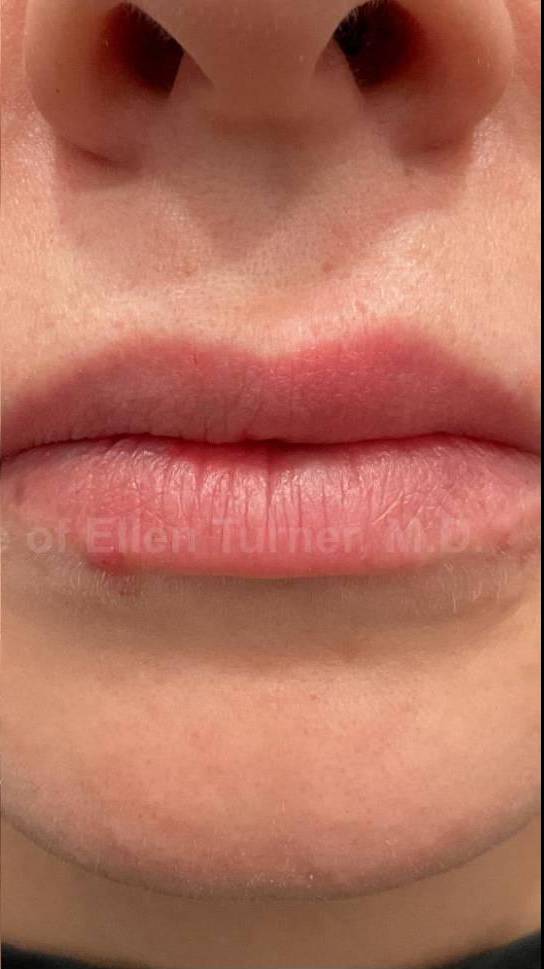 Restylane Before and After Case 17 After