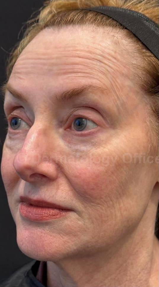 Restylane Before and After Case 16 Before