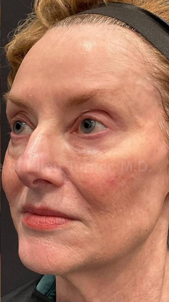 Restylane Before and After Case 16 After