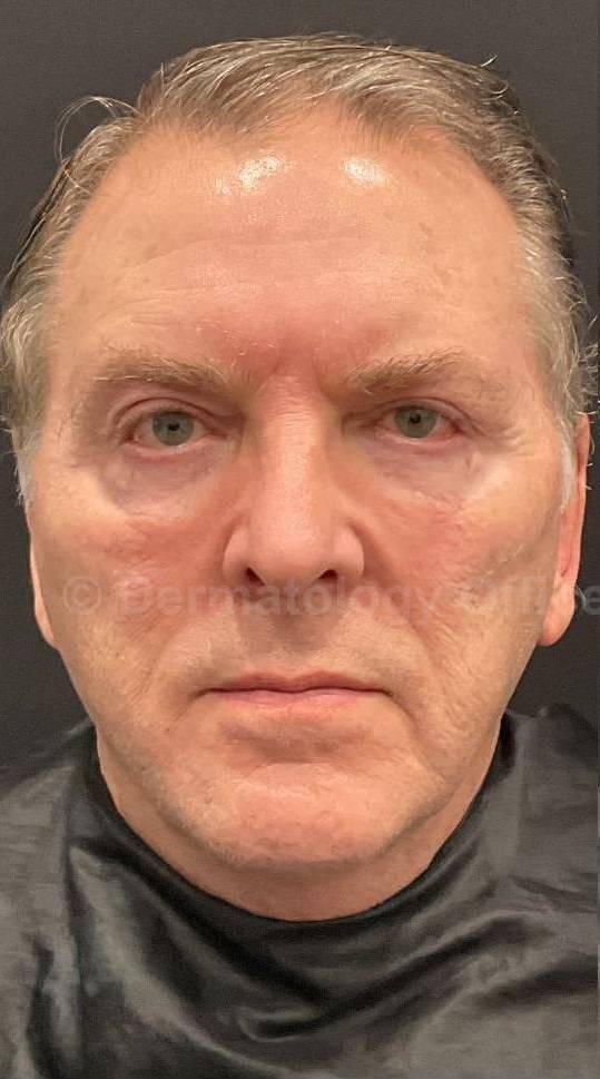 Restylane Before and After Case 14 Before