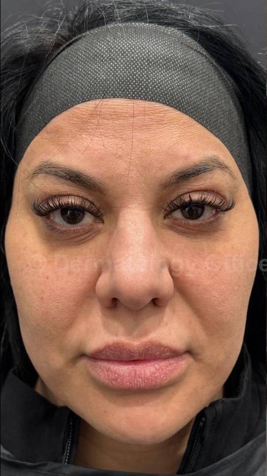 Restylane Before and After Case 13 Before