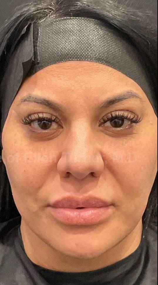 Restylane Before and After Case 13 After