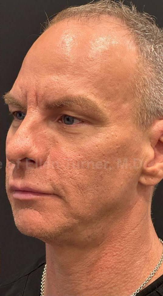 Restylane Before and After Case 12 After