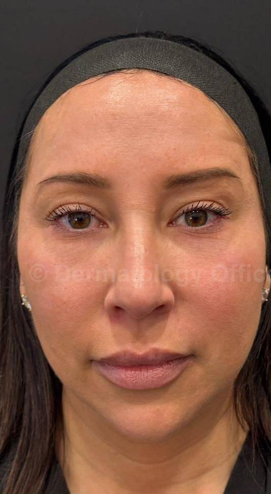 Restylane Before and After Case 11 Before