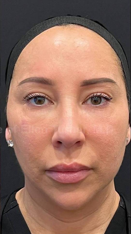 Restylane Before and After Case 11 After