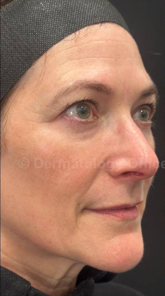 Restylane Before and After Case 10 Before