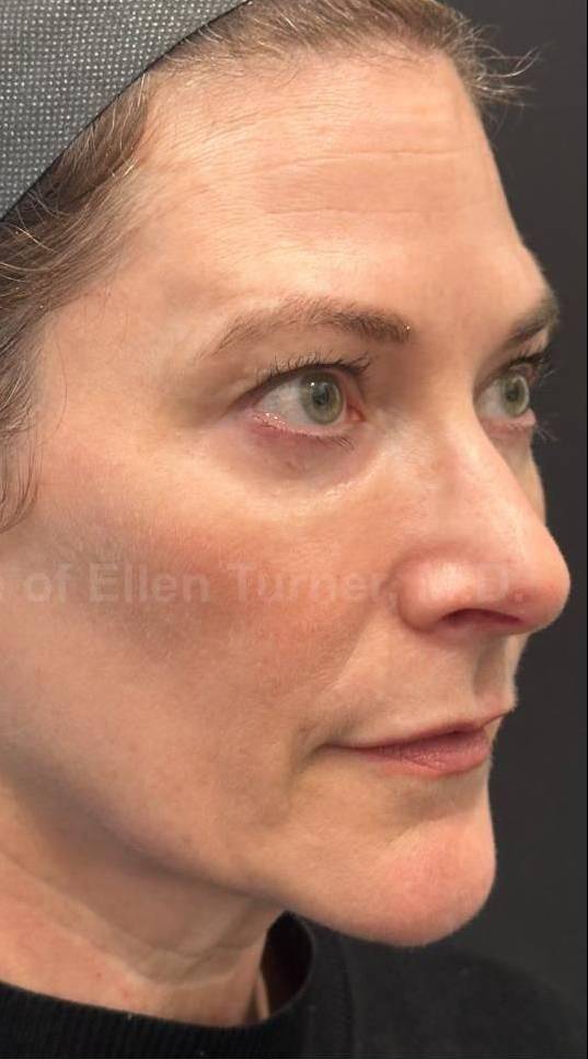 Restylane Before and After Case 10 After