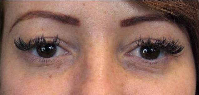 Restylane Before and After Case 7 Before