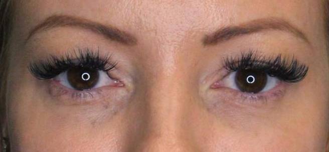 Restylane Before and After Case 7 After