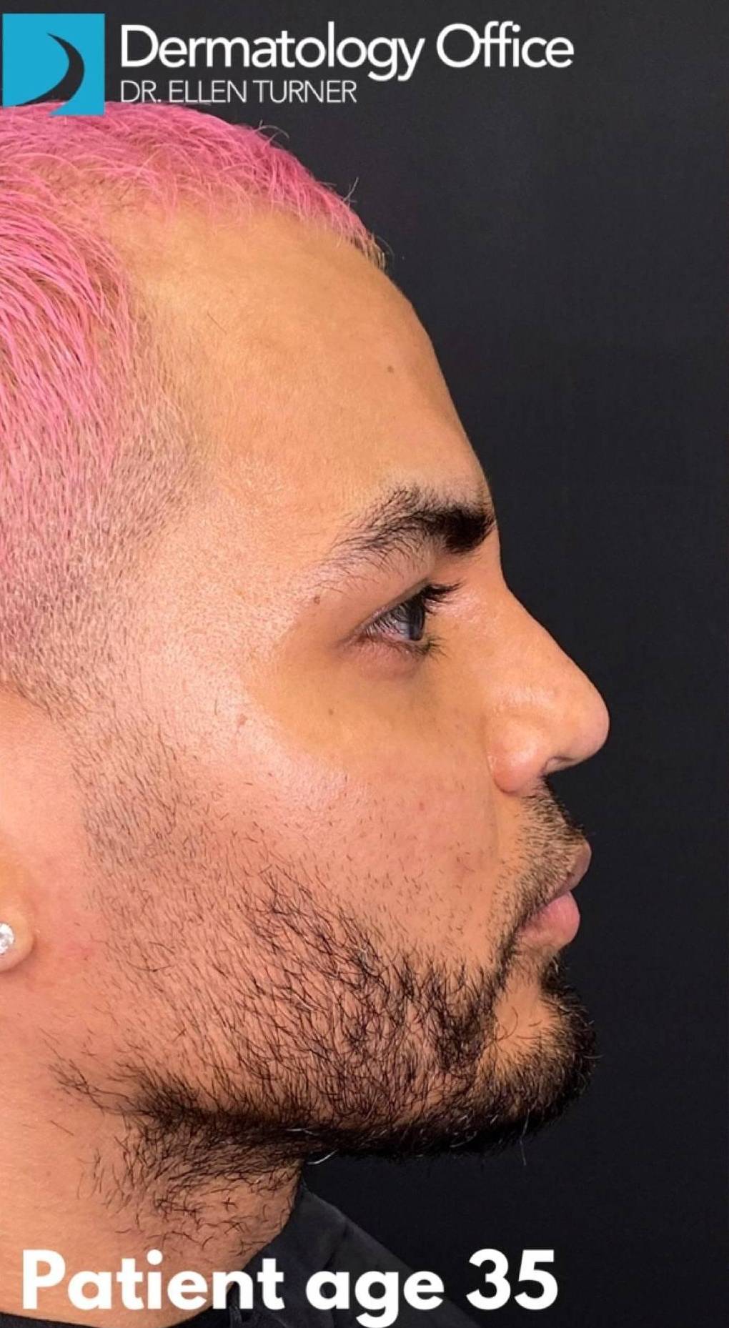 Teoxane RHA Filler (4 Syringes RHA4) Case 4 Before