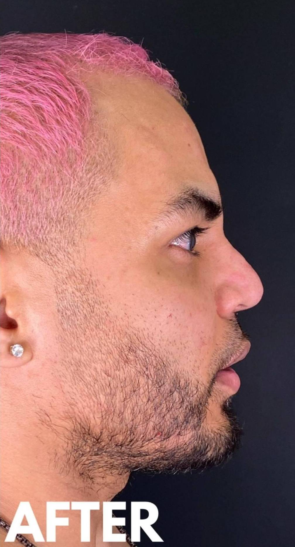 Teoxane RHA Filler (4 Syringes RHA4) Case 4 After