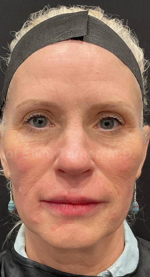 Teoxane Revance Filler Case 8 After