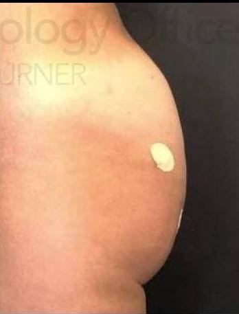 Sculptra (15 Vials) Case 1 After