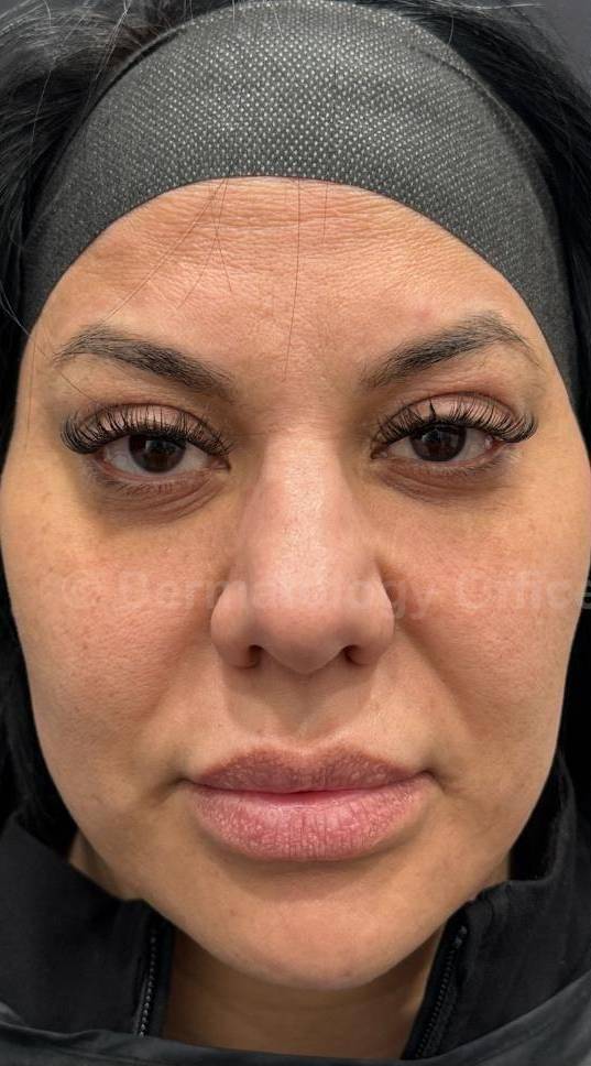 Sculptra Before and After Case 8 Before