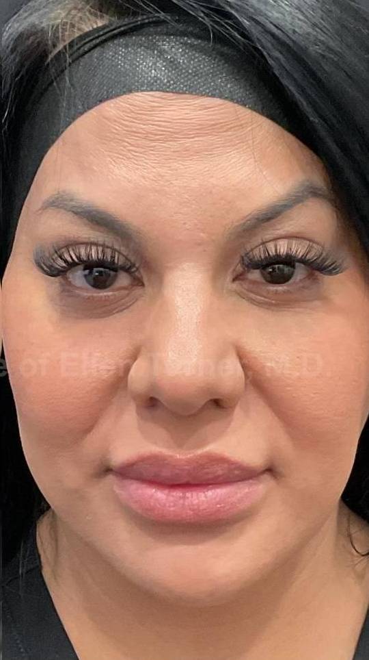 Sculptra Before and After Case 8 After