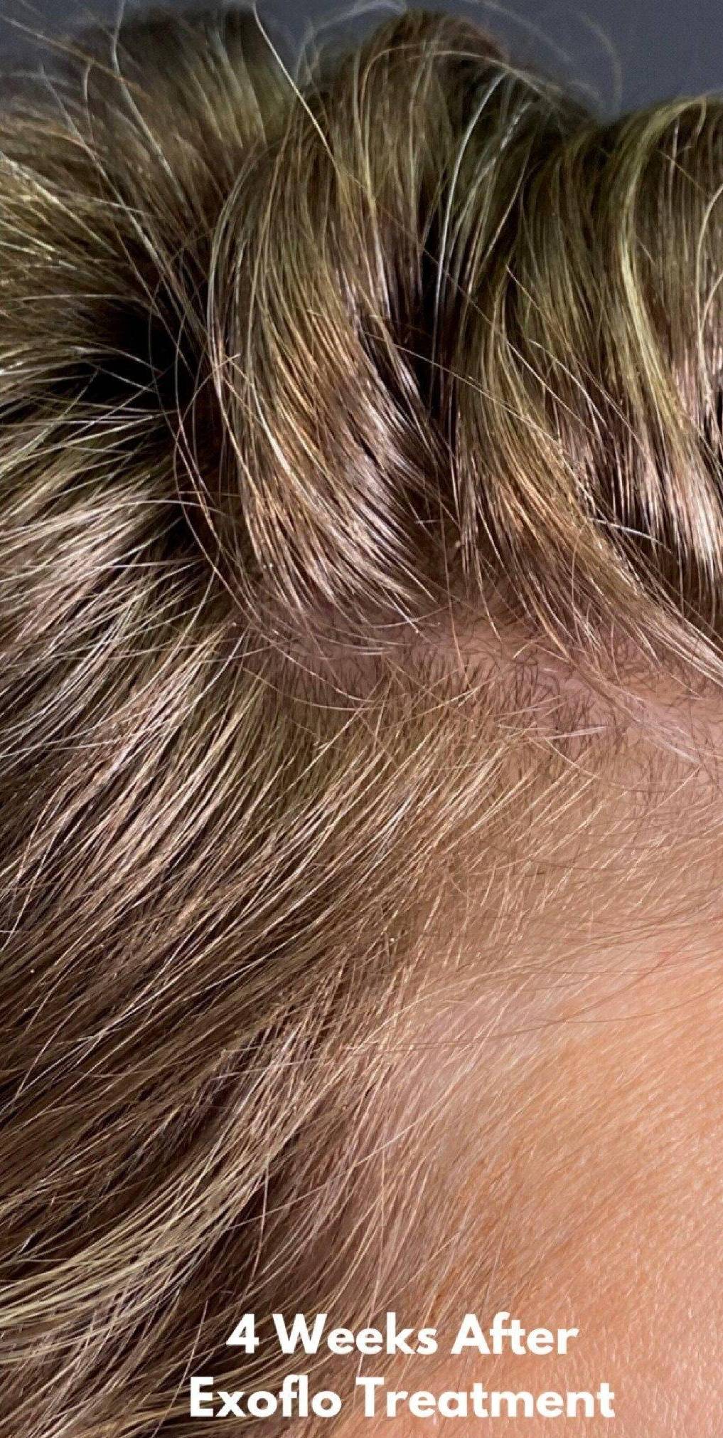 Exoflo-Hair Restoration Before and After Case 1 After